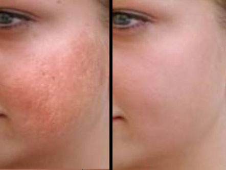 Laser Hair Removal Surgery in Jaipur
